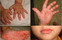 یک بیماری جدید به اسم «دست،‌پا و دهان» شیوع پیدا کرده؟/ توضیحات یک متخصص