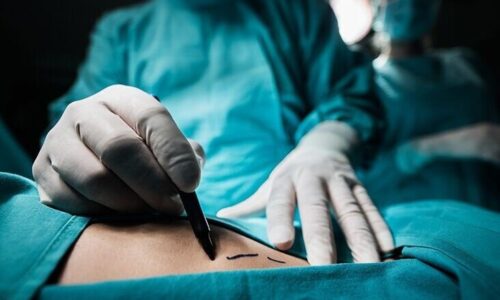 مرگ در اتاق عمل؛ از لیپوساکشن تا جراحی روده…